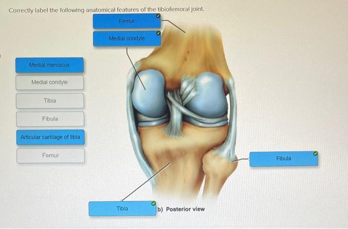 Learn to Correctly Label the Following Anatomical Features of the Tibiofemoral Joint with Ease.