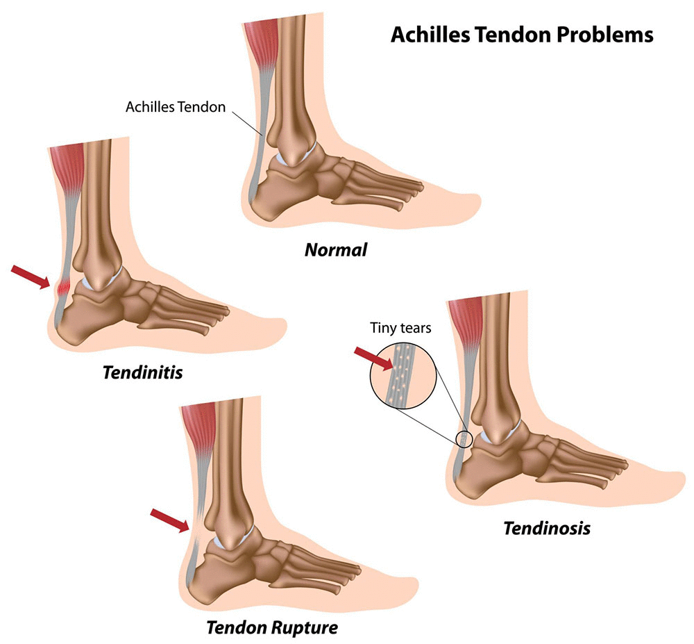 Achilles Hurts When I Run: Common Causes and Fixes!