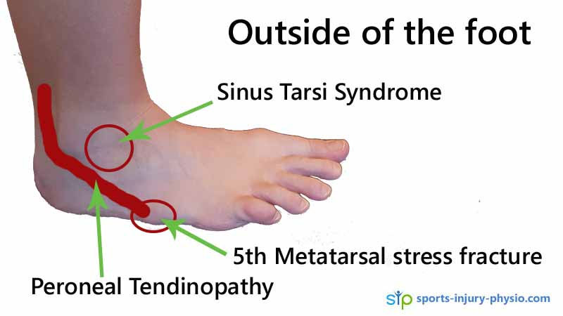 Foot Pain After Running: (Easy Guide to Understanding and Treating Pain on the Outside of the Foot)